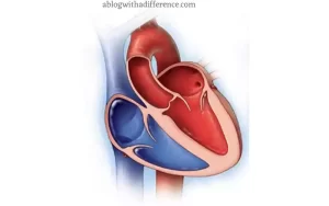 Dilated Cardiomyopathy