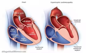 Hypertrophic Cardiomyopathy