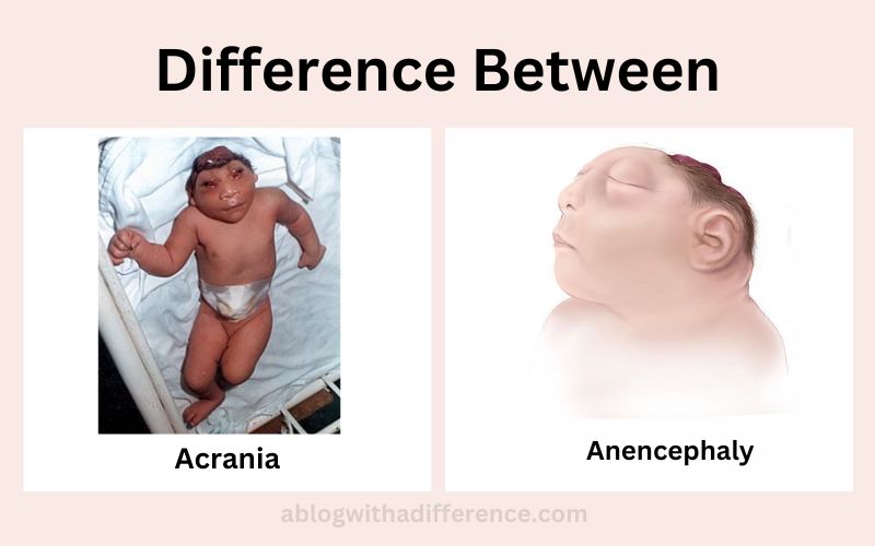 Acrania and Anencephaly