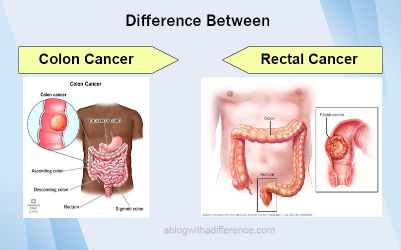 Colon and Rectal Cancer
