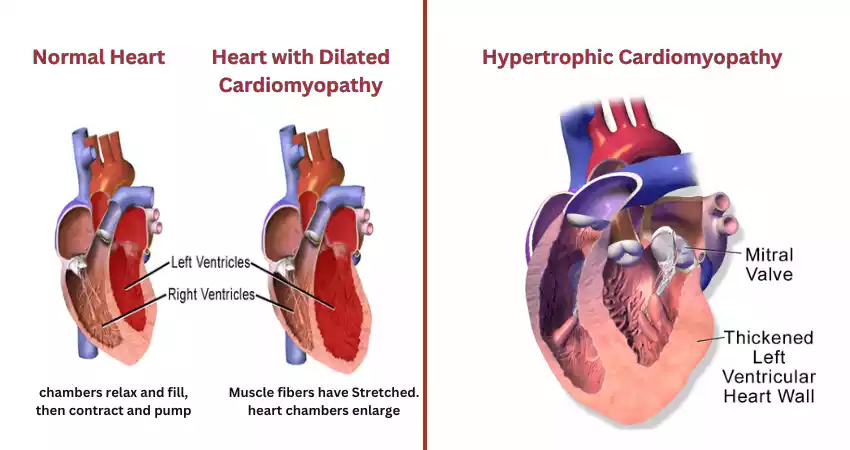 Difference Between Dilated Cardiomyopathy and Hypertrophic Cardiomyopathy