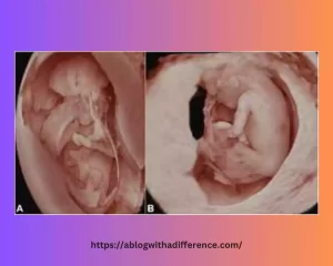 Acrania and Anencephaly