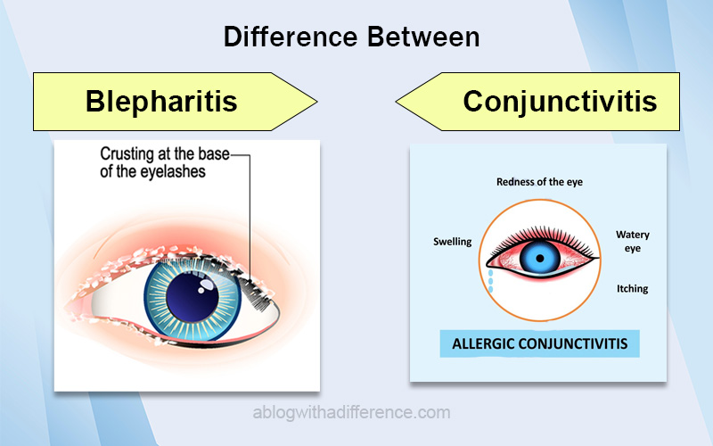 Blepharitis and Conjunctivitis
