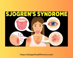 Lupus and Sjogren's Syndrome