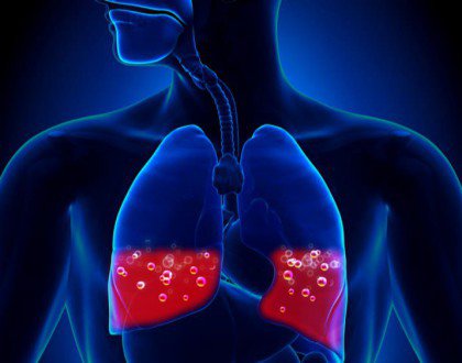 Noncardiogenic Pulmonary Edema