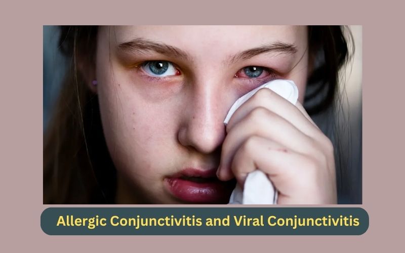 Allergic Conjunctivitis and Viral Conjunctivitis
