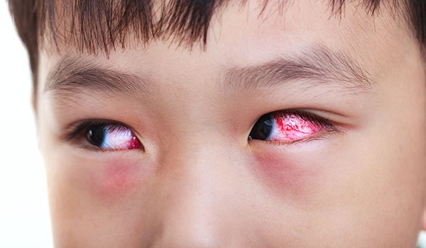 Allergic Conjunctivitis