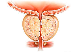 BPH (Benign Prostatic Hyperplasia)