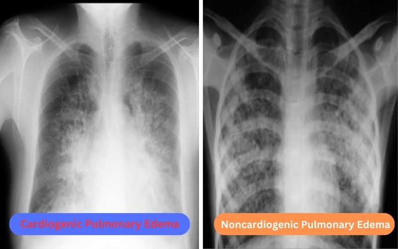 Cardiogenic and Noncardiogenic Pulmonary Edema