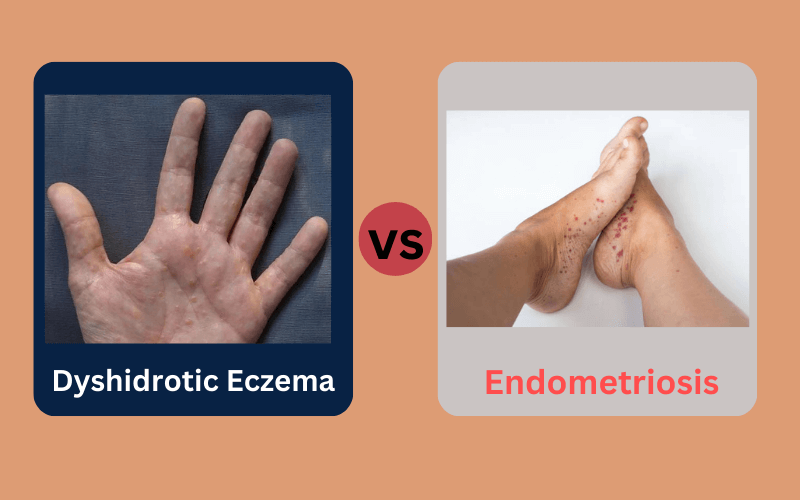 Dyshidrotic Eczema and Herpetic Whitlow