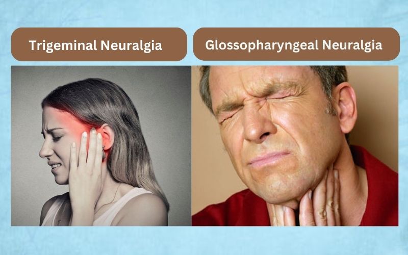 Glossopharyngeal Neuralgia and Trigeminal Neuralgia