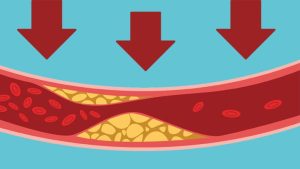 LDL Cholesterol