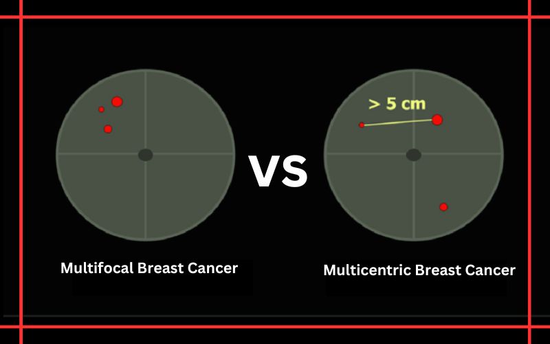 Multifocal and Multicentric Breast Cancer
