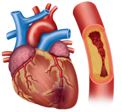 Myocardial Infarction