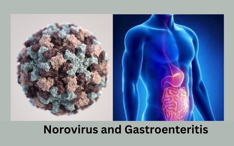 Top 15 Ways Difference Between Norovirus and Gastroenteritis