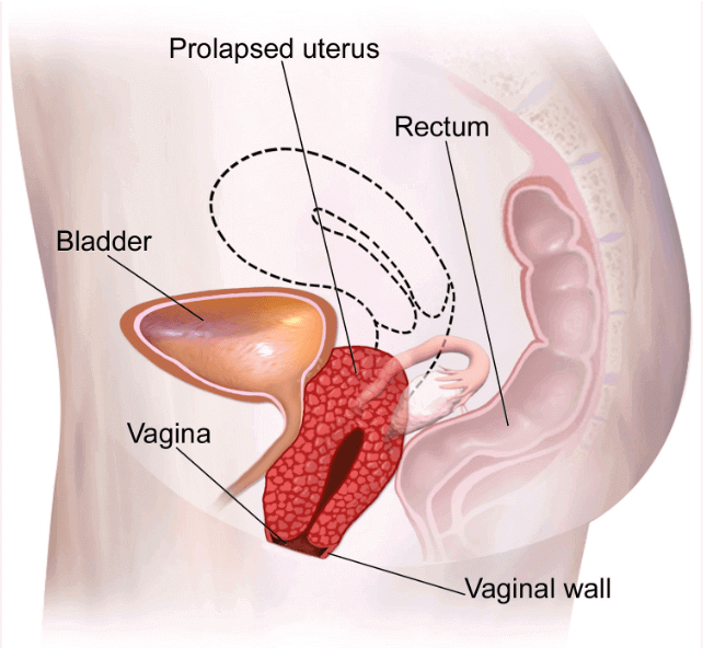  Prolapsed Uterus