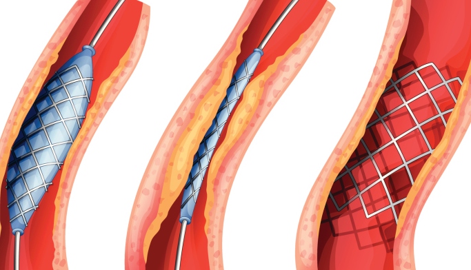 Sent Thrombosis