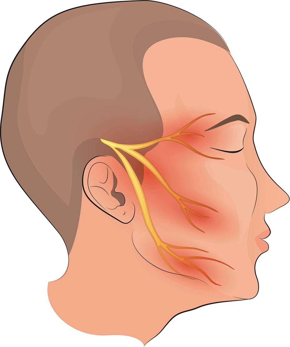 Trigeminal Neuralgia