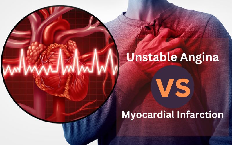 Unstable Angina and Myocardial Infarction