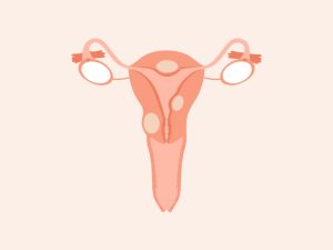 Uterine Fibroids