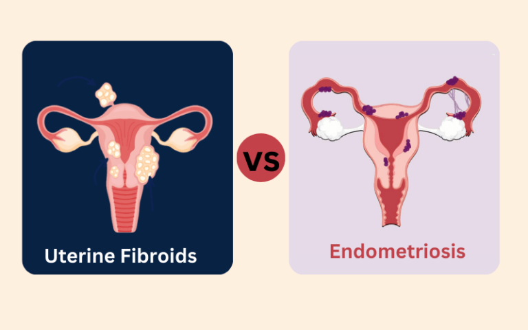 Top 10 Facts About Uterine Fibroids And Endometriosis A Blog With A