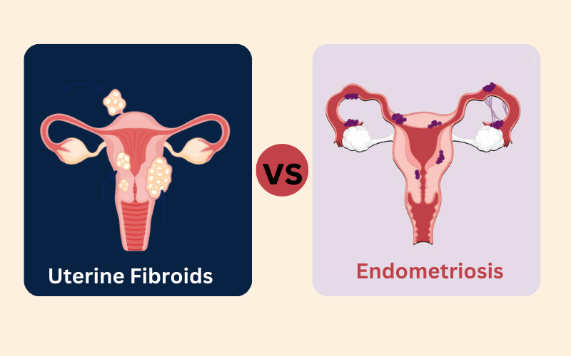 Uterine Fibroids and Endometriosis