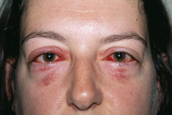 Viral Conjunctivitis