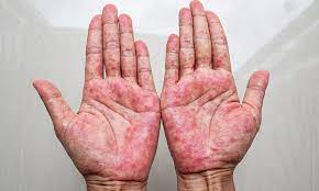  Dyshidrotic Eczema