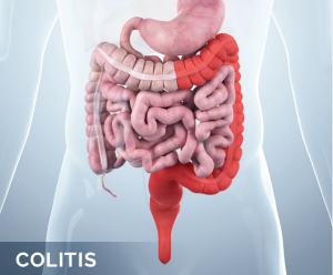 Colitis