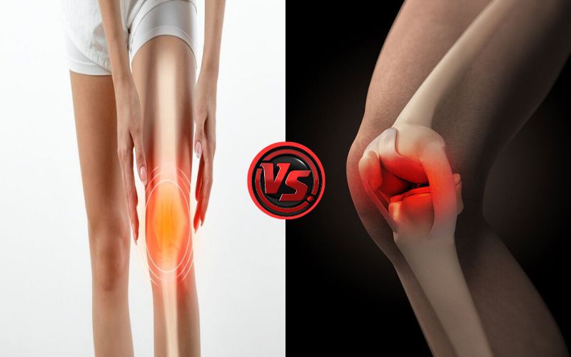 ACL and Meniscus Tear