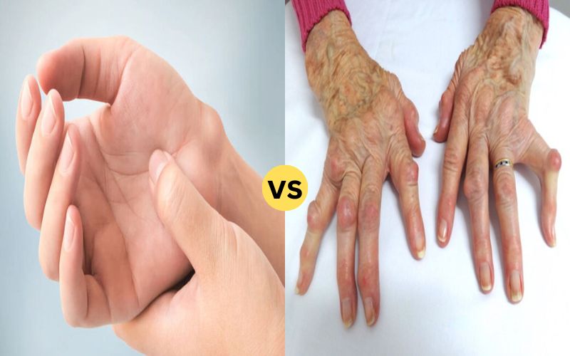 Difference Between  Ganglion Cyst and RA Nodule