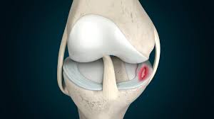 Meniscus Tear