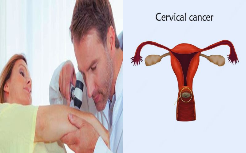 Squamous Cell Carcinoma and Adenocarcinoma Cervix
