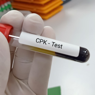 CPK Blood Test