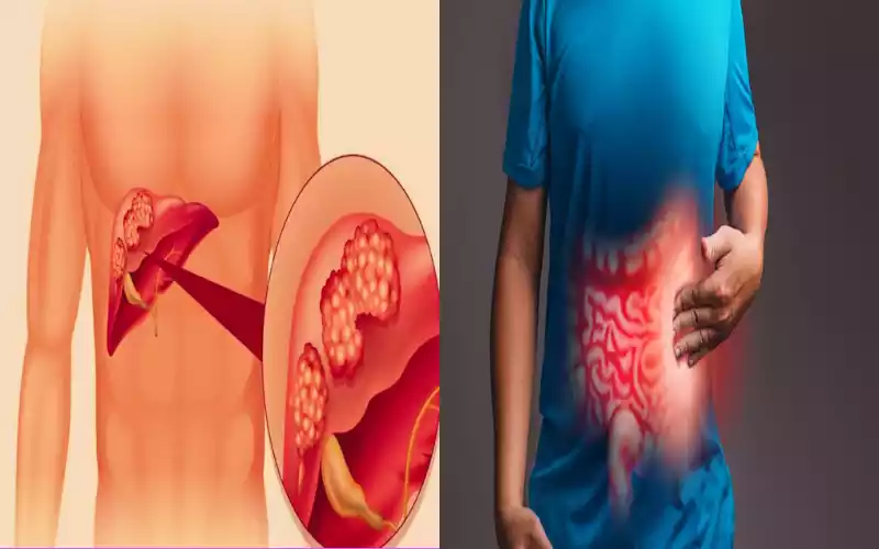 9 Amazing Secret about Hepatomegaly and Fatty Liver