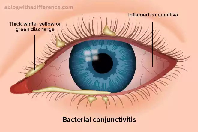 Conjunctivitis