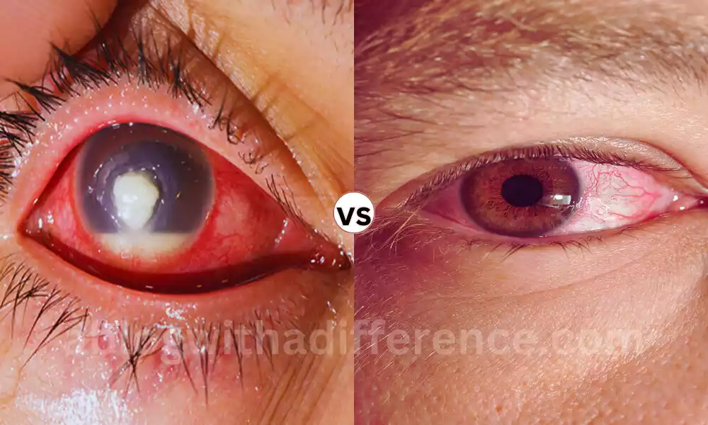 Difference Between Keratitis and Conjunctivitis