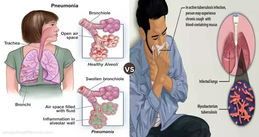 Difference Between Tuberculosis and Pneumonia