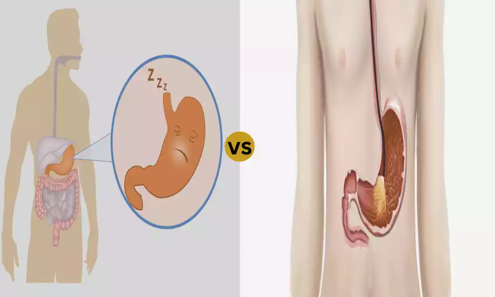 What is the Difference Between Gastroparesis and Dumping Syndrome