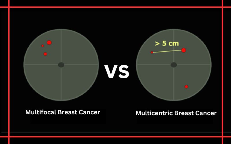 Fact Check: 10 Common Misconceptions About Multifocal and Multicentric Breast Cancer