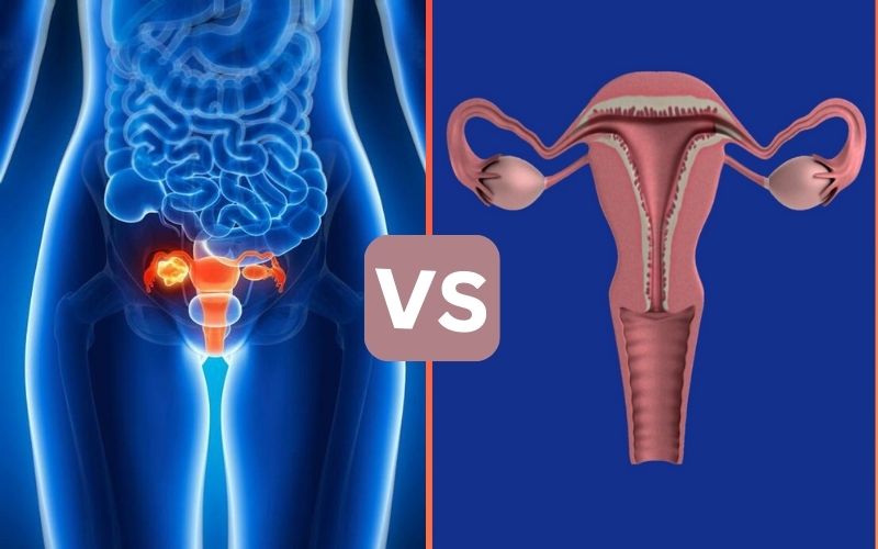 Difference Between Prolapsed Bladder and Prolapsed Uterus