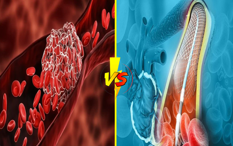 Top 9 Differences Between Stent Thrombosis and Restenosis